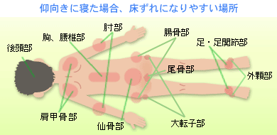 床ずれになりやすい場所